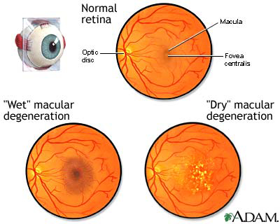 Macular Degeneration Ocular