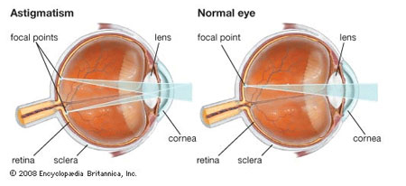 Astigmatism Ocular Conditions