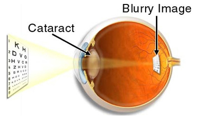 Cataract Treatment