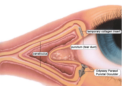 Dry Eyes Treatment