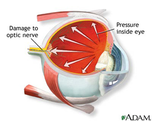 Glaucoma Treatment