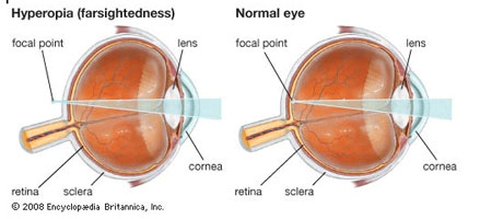 Hyperopia Ocular Conditions