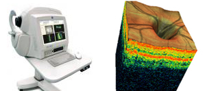 Ocular Coherence Tomography