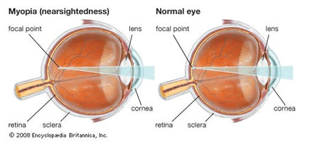 Myopia Ocular Condition